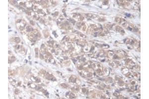 DAB staining on IHC-P; Samples: Human Breast cancer Tissue