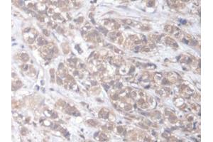 DAB staining on IHC-P; Samples: Human Breast cancer Tissue (ELMO2 anticorps  (AA 501-720))