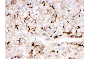 APOA1 was detected in paraffin-embedded sections of human liver cancer tissues using rabbit anti- APOA1 Antigen Affinity purified polyclonal antibody (Catalog # ) at 1 µg/mL. (APOA1 anticorps  (AA 25-267))