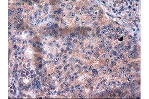 Immunohistochemical staining of paraffin-embedded Carcinoma of kidney using anti-KRT18 (ABIN2452674) mouse monoclonal antibody. (Cytokeratin 18 anticorps  (AA 69-372))