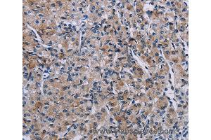 Immunohistochemistry of Human prostate cancer using KDM4D Polyclonal Antibody at dilution of 1:50 (JMJD2D anticorps)