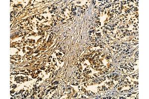 ABIN7094909 and ABIN7098963 at 1/100 staining human pancreatic cancer by IHC-P. (IL23 anticorps)
