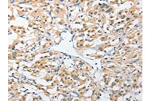 The image on the left is immunohistochemistry of paraffin-embedded Human thyroid cancer tissue using ABIN7131538(UCHL5 Antibody) at dilution 1/25, on the right is treated with fusion protein.