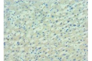 Immunohistochemistry of paraffin-embedded human lung cancer using ABIN7162506 at dilution of 1:100