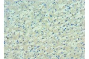 Immunohistochemistry of paraffin-embedded human lung cancer using ABIN7162506 at dilution of 1:100 (PAX7 anticorps  (AA 291-520))