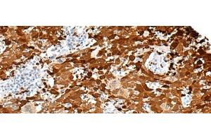 Immunohistochemistry of paraffin-embedded Human cervical cancer tissue using FGD3 Polyclonal Antibody at dilution of 1:50(x200) (FGD3 anticorps)