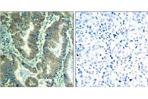 Immunohistochemical analysis of paraffin-embedded human lung carcinoma tissue using α -catenin (Ab-177) Antibody (E021521). (CTNNA1 anticorps)