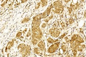 Immunohistochemical analysis of paraffin-embedded Human Breast cancer section using Pink1 (ABIN1944789 and ABIN2838529).