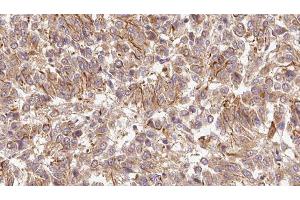 ABIN6278955 at 1/100 staining Human Melanoma tissue by IHC-P. (WNT6 anticorps  (Internal Region))
