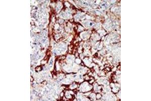 Formalin-fixed and paraffin-embedded human cancer tissue reacted with the primary antibody, which was peroxidase-conjugated to the secondary antibody, followed by DAB staining. (CDKL1 anticorps  (C-Term))