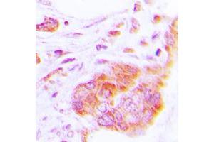 Immunohistochemical analysis of COX17 staining in human lung cancer formalin fixed paraffin embedded tissue section. (COX17 anticorps  (N-Term))