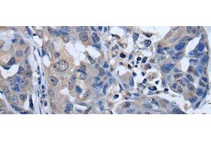 Immunohistochemistry of paraffin-embedded Human breast cancer tissue using PLK4 Polyclonal Antibody at dilution of 1:50(x200) (PLK4 anticorps)