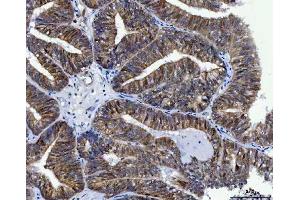 IHC analysis of Thymidylate Synthase/TYMS using anti-Thymidylate Synthase/TYMS antibody (ABIN7599260).
