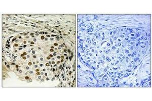 Immunohistochemical analysis of paraffin-embedded human breast carcinoma tissue using OSR1 (Phospho-Thr185) antibody (left)or the same antibody preincubated with blocking peptide (right).