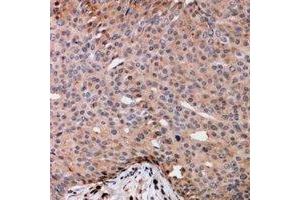 Immunohistochemical analysis of TRAK2 staining in human breast cancer formalin fixed paraffin embedded tissue section. (TRAK2 anticorps)