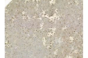 ABIN6257065 and ABIN6275006 at 1/100 staining human melanoma by IHC-P.