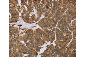 Immunohistochemistry of Human prostate cancer using IKBIP Polyclonal Antibody at dilution of 1:40 (IKbIP anticorps)