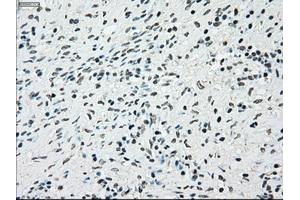 Immunohistochemical staining of paraffin-embedded Adenocarcinoma of breast tissue using anti-BRAF mouse monoclonal antibody. (BRAF anticorps)