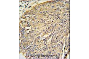 Annexin A1 Antibody IHC analysis in formalin fixed and paraffin embedded human lung carcinoma followed by peroxidase conjugation of the secondary antibody and DAB staining. (Annexin a1 anticorps  (AA 129-158))