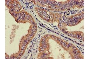 Immunohistochemistry of paraffin-embedded human endometrial cancer using ABIN7142516 at dilution of 1:100 (RPS21 anticorps  (AA 1-81))