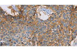 Immunohistochemistry of paraffin-embedded Human lung cancer using CDCP1 Polyclonal Antibody at dilution of 1:50 (CDCP1 anticorps)