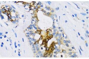 Immunohistochemistry of paraffin-embedded Human breast using PTCH1 Polyclonal Antibody at dilution of 1:100 (40x lens).