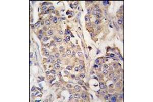 Formalin-fixed and paraffin-embedded human breast carcinoma tissue reacted with ACO2 antibody (Center), which was peroxidase-conjugated to the secondary antibody, followed by DAB staining. (ACO2 anticorps  (Middle Region))