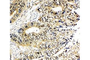 IHC-P: NME2 antibody testing of human intestinal cancer tissue
