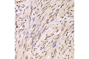 Immunohistochemistry of paraffin-embedded human adenomyosis using SNRPA Antibody (ABIN5973811) at dilution of 1/100 (40x lens). (SNRPA1 anticorps)