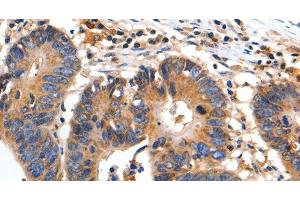 Immunohistochemistry of paraffin-embedded Human colon cancer using FADD Polyclonal Antibody at dilution of 1:35 (FADD anticorps)