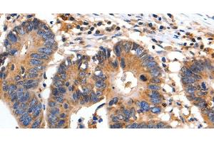 Immunohistochemistry of paraffin-embedded Human colon cancer using FADD Polyclonal Antibody at dilution of 1:35