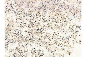 ABIN6258864 and ABIN6273547 at 1/100 staining human pituitary adenoma by IHC-P. (KDM3B anticorps  (Internal Region))