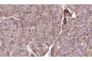 ABIN6273289 at 1/100 staining Human pancreas cancer tissue by IHC-P. (PCMT1 anticorps  (Internal Region))