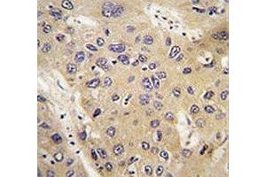 IHC analysis of FFPE human hepatocarcinoma tissue and lung carcinoma tissue stained with ATG12 antibody