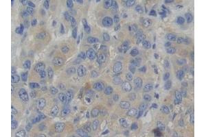 Detection of WARS in Human Breast cancer Tissue using Polyclonal Antibody to Tryptophanyl tRNA Synthetase (WARS)