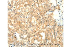 Immunohistochemistry of Human thyroid cancer using SNAP25 Polyclonal Antibody at dilution of 1:25 (SNAP25 anticorps)