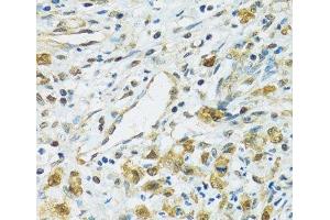 Immunohistochemistry of paraffin-embedded Human uterine cancer using RPS7 Polyclonal Antibody at dilution of 1:100 (40x lens).