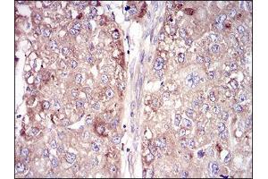 Immunohistochemical analysis of paraffin-embedded liver cancer tissues using VTN mouse mAb with DAB staining.