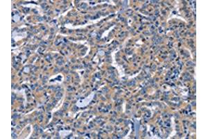The image on the left is immunohistochemistry of paraffin-embedded Human thyroid cancer tissue using ABIN7191592(NCR2 Antibody) at dilution 1/60, on the right is treated with synthetic peptide. (NKp44/NCR2 anticorps)