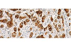 Immunohistochemistry of paraffin-embedded Human liver cancer tissue using SAA1 Polyclonal Antibody at dilution of 1:70(x200) (SAA1 anticorps)