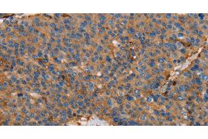 Immunohistochemistry of paraffin-embedded Human liver cancer using ACTA1 Polyclonal Antibody at dilution of 1:65 (Actin anticorps)