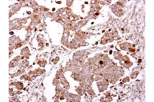 IHC-P Image beta-Gal antibody [N2C3] detects beta-Gal protein at cytosol on human ovarian carcinoma by immunohistochemical analysis. (GLB1 anticorps)