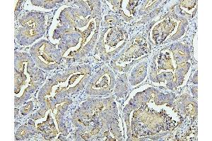 IHC analysis of CEACAM5 using anti-CEACAM5 antibody (ABIN7601435). (CEACAM5 anticorps  (AA 35-650))