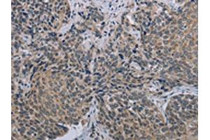 The image on the left is immunohistochemistry of paraffin-embedded Human cervical cancer tissue using ABIN7191408(MARVELD1 Antibody) at dilution 1/40, on the right is treated with synthetic peptide. (MARVELD1 anticorps)