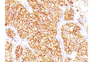 Formalin-fixed, paraffin-embedded human Renal Cell Carcinoma stained with RCC Mouse Monoclonal Antibody (66. (CA9 anticorps)