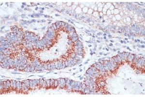 Immunohistochemistry of paraffin-embedded Human colon carcinoma using TFRC Polyclonal Antibody at dilution of 1:100 (40x lens).