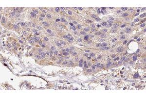 ABIN6279108 at 1/100 staining Human melanoma tissue by IHC-P. (alpha 2 Antiplasmin anticorps  (C-Term))