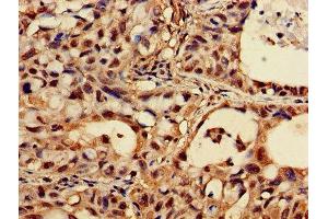 Immunohistochemistry of paraffin-embedded human lung cancer using ABIN7162924 at dilution of 1:100 (CASK anticorps  (AA 470-760))