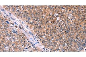 Immunohistochemistry of paraffin-embedded Human ovarian cancer tissue using EDN1 Polyclonal Antibody at dilution 1:50 (Endothelin 1 anticorps)