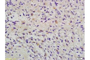 Formalin-fixed and paraffin embedded human glioma labeled with Anti-RAB-14 Polyclonal Antibody, Unconjugated (ABIN681898) at 1:200 followed by conjugation to the secondary antibody and DAB staining (RAB14 anticorps  (AA 21-120))
